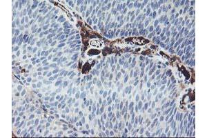 Immunohistochemical staining of paraffin-embedded Carcinoma of Human bladder tissue using anti-IGJ mouse monoclonal antibody. (IGJ Antikörper)