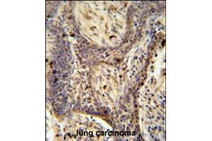 PPRC1 antibody immunohistochemistry analysis in formalin fixed and paraffin embedded human lung carcinoma followed by peroxidase conjugation of the secondary antibody and DAB staining. (PPRC1 Antikörper  (C-Term))