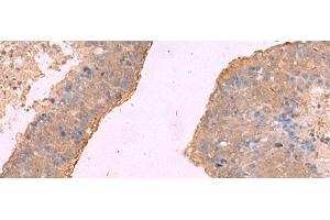 Immunohistochemistry of paraffin-embedded Human liver cancer tissue using NIPSNAP1 Polyclonal Antibody at dilution of 1:50(x200)