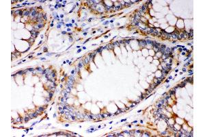 Anti- BAK Picoband antibody, IHC(P) IHC(P): Human Intestinal Cancer Tissue (BAK1 Antikörper  (AA 22-211))