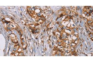 Immunohistochemistry of paraffin-embedded Human breast cancer using NDUFS1 Polyclonal Antibody at dilution of 1:50 (NDUFS1 Antikörper)