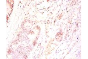 Immunohistochemistry of paraffin-embedded human colon cancer using ABIN7165346 at dilution of 1:50 (TMEM185B Antikörper  (AA 1-370))
