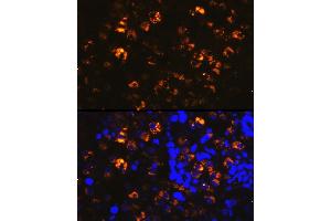 Immunofluorescence analysis of human lung cancer cells using NAPSA Rabbit pAb (ABIN6128367, ABIN6144368, ABIN6144369 and ABIN6221232) at dilution of 1:100 (40x lens). (NAPSA Antikörper  (AA 25-250))
