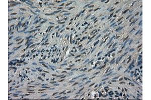 Immunohistochemical staining of paraffin-embedded Carcinoma of kidney tissue using anti-TRIB2mouse monoclonal antibody. (TRIB2 Antikörper)