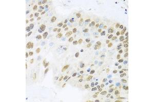 Immunohistochemistry of paraffin-embedded human lung cancer using ZBTB17 antibody (ABIN6133380, ABIN6150370, ABIN6150371 and ABIN6224531) at dilution of 1:100 (40x lens). (ZBTB17 Antikörper  (AA 121-360))