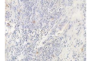 ABIN6265908 and ABIN6266672 at 1/100 staining human cervical carcinoma by IHC-P.