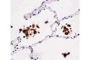Immunohistochemical analysis of paraffin-embedded human lung using FABP4 antibody at 1:25 dilution. (FABP4 Antikörper)