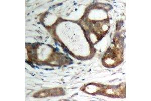 Immunohistochemical analysis of Plakophilin 2 staining in human prostate cancer formalin fixed paraffin embedded tissue section. (Plakophilin 2 Antikörper  (C-Term))