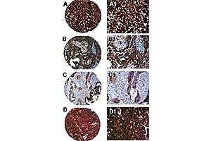 Immunohistochemisty of PTPN13 in formalin-fixed, paraffin embedded ovarian carcinoma cores from a tissue microarray.