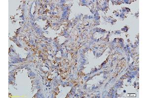 Formalin-fixed and paraffin embedded human endometrial cancer labeled with Anti-CCL19/MIP-3 beta Polyclonal Antibody, Unconjugated (ABIN740505) followed by conjugation to the secondary antibody (CCL19 Antikörper  (AA 26-108))