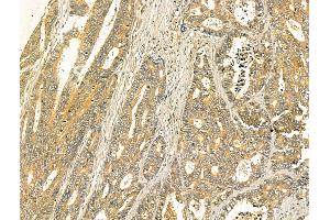 ABIN7094411 and ABIN7098458 at 1/100 staining Human colorectal cancer by IHC-P. (ODF2L Antikörper  (N-Term))