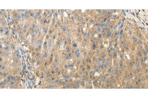 Immunohistochemistry of paraffin-embedded Human ovarian cancer using SULT1E1 Polyclonal Antibody at dilution of 1:30 (SULT1E1 Antikörper)