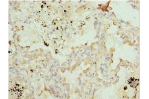 Immunohistochemistry of paraffin-embedded human lung cancer using ABIN7165145 at dilution of 1:100 (BTG1 Antikörper  (AA 22-171))