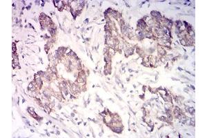 Immunohistochemical analysis of paraffin-embedded stomach cancer tissues using CYCS mouse mAb with DAB staining. (Cytochrome C Antikörper  (AA 1-105))
