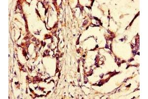 Immunohistochemistry of paraffin-embedded human gastric cancer using ABIN7168184 at dilution of 1:100 (MSK2 Antikörper  (AA 237-393))