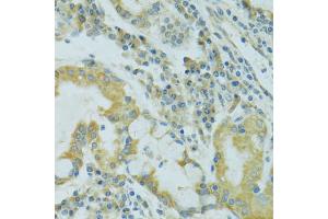 Immunohistochemistry of paraffin-embedded human lung cancer using TJP2 antibody. (TJP2 Antikörper)