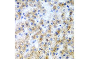 Immunohistochemistry of paraffin-embedded human liver cancer using LY86 antibody at dilution of 1:200 (40x lens). (LY86 Antikörper)