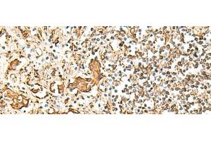 Immunohistochemistry of paraffin-embedded Human prost at e cancer tissue using HLA-DRB1 Polyclonal Antibody at dilution of 1:75(x200) (HLA-DRB1 Antikörper)