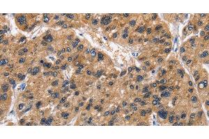 Immunohistochemistry of paraffin-embedded Human liver cancer tissue using ABI3BP Polyclonal Antibody at dilution 1:50 (ABI3BP Antikörper)