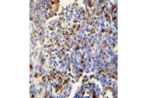 Immunohistochemistry analysis in formalin fixed andparaffin embedded human lung carcinoma reactedwith FOSL2 Antibody (Center) Cat. (FOSL2 Antikörper  (Middle Region))