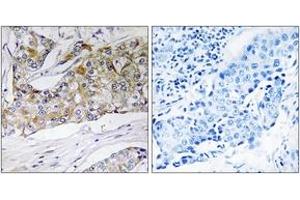 Immunohistochemistry analysis of paraffin-embedded human breast carcinoma tissue, using DHRS11 Antibody. (DHRS11 Antikörper  (AA 111-160))