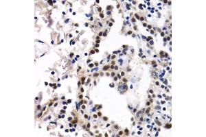 Immunohistochemistry of paraffin-embedded human lung cancer using ID3 antibody. (ID3 Antikörper)