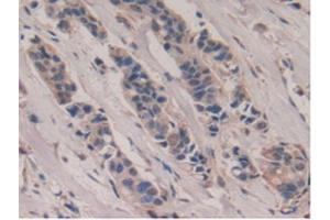 IHC-P analysis of Human Breast Cancer Tissue, with DAB staining. (Poliovirus Receptor Antikörper  (AA 56-309))