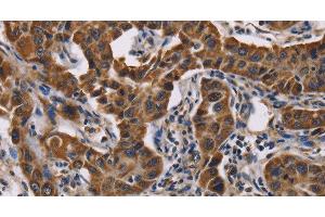 Immunohistochemistry of paraffin-embedded Human lung cancer tissue using GRK3 Polyclonal Antibody at dilution 1:50 (ADRBK2 Antikörper)