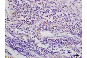 Formalin-fixed and paraffin embedded human esophagus carcinoma labeled with Anti-phospho-LKB1 (Thr363) Polyclonal Antibody, Unconjugated (ABIN687877) at 1:200 followed by conjugation to the secondary antibody and DAB staining (LKB1 Antikörper  (pThr363))