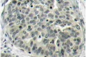 Immunohistochemistry (IHC) analyzes of p-Catenin-beta antibody in paraffin-embedded human breast carcinoma tissue. (CTNNB1 Antikörper  (pSer37))