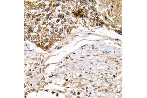 Immunohistochemistry of paraffin-embedded human mammary cancer using ARRB2 antibody. (Arrestin 3 Antikörper)