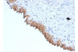 IHC testing of FFPE human bladder carcinoma with MAML2 antibody (clone MAML2/1302). (MAML2 Antikörper)