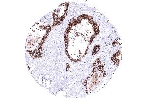 Colon Colorectal adenocarcinoma with strong CDH17 immunostaining of all tumor cells CDH17 immunohistochemistry (LI Cadherin Antikörper  (AA 242-418))