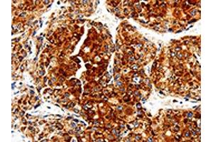The image is immunohistochemistry of paraffin-embedded Human liver cancer tissue using ABIN7129012(COX19 Antibody) at dilution 1/50.