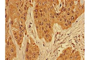 Immunohistochemistry of paraffin-embedded human cervical cancer using ABIN7142728 at dilution of 1:100 (RPL10L Antikörper  (AA 1-214))