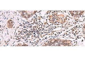 Immunohistochemistry of paraffin-embedded Human esophagus cancer tissue using ARIH2 Polyclonal Antibody at dilution of 1:80(x200) (ARIH2 Antikörper)