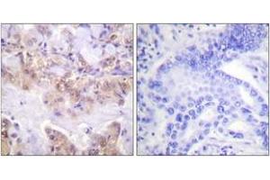 Immunohistochemistry analysis of paraffin-embedded human lung carcinoma, using C-RAF (Phospho-Ser621) Antibody. (RAF1 Antikörper  (pTyr621))