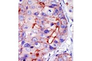 Formalin-fixed and paraffin-embedded human cancer tissue (hepatocarcinoma) reacted with the primary antibody, which was peroxidase-conjugated to the secondary antibody, followed by DAB staining.