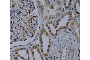 Immunohistochemistry of paraffin-embedded Human kidney cancer using WDR5 Polyclonal Antibody at dilution of 1:200 (40x lens). (WDR5 Antikörper)