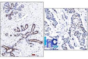 Formalin-fixed, paraffin-embedded normal human breast (left) and invasive ductal carcinoma (right) stained with progesterone receptor Ab (PR501). (Progesterone Receptor Antikörper)