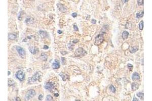 Immunohistochemical staining of formalin-fixed paraffin-embedded human liver tissue showing membrane staining with AKR1A1 polyclonal antibody  at 1 : 100 dilution. (AKR1A1 Antikörper  (AA 132-310))
