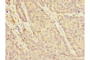 Immunohistochemistry of paraffin-embedded human ovarian cancer using ABIN7167162 at dilution of 1:100 (IQGAP3 Antikörper  (AA 1437-1631))