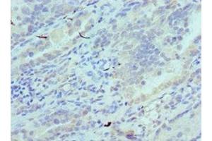 Immunohistochemistry of paraffin-embedded human lung cancer using ABIN7147246 at dilution of 1:100 (CADM1 Antikörper  (AA 45-344))
