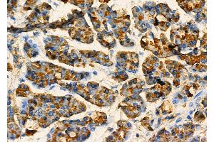 ABIN6260889 and ABIN6277320 at 1/100 staining Human pancreatic cancer and adjacent nomal tissues by IHC-P.