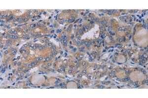 Immunohistochemistry of paraffin-embedded Human thyroid cancer using P2RX3 Polyclonal Antibody at dilution of 1:50 (P2RX3 Antikörper)