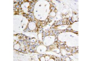 Immunohistochemical staining of paraffin embedded human breast cancer tissue section with DLD polyclonal antibody . (DLD Antikörper  (C-Term))