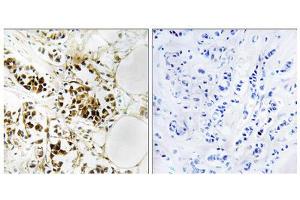 Immunohistochemistry analysis of paraffin-embedded human breast carcinoma tissue, using RGS5 antibody. (RGS5 Antikörper  (Internal Region))