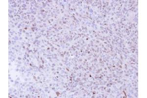 IHC-P Image Immunohistochemical analysis of paraffin-embedded H1299 Xenograft , using NGFRAP1, antibody at 1:100 dilution. (Nerve Growth Factor Receptor (TNFRSF16) Associated Protein 1 (NGFRAP1) (Center) Antikörper)