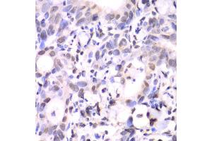 Immunohistochemistry of paraffin-embedded human gastric cancer using HAT1 antibody at dilution of 1:100 (x40 lens). (HAT1 Antikörper)
