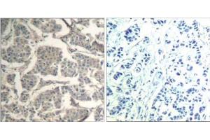 Immunohistochemical analysis of paraffin-embedded human breast carcinoma tissue using cofilin1/cofilin2 (Ab -88) Antibody (E021507). (Cofilin1/2 (CFL1/2) Antikörper)